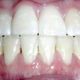 after-orthodontics