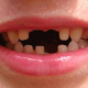 low-tooth
