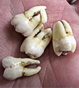 remove-tooth